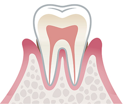 軽度歯周病