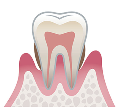 中度歯周病