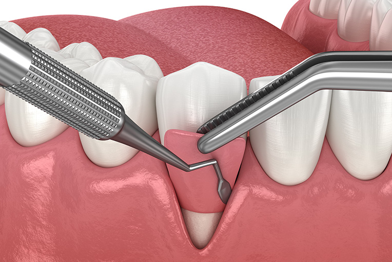 歯ぐきの手術（歯周外科）